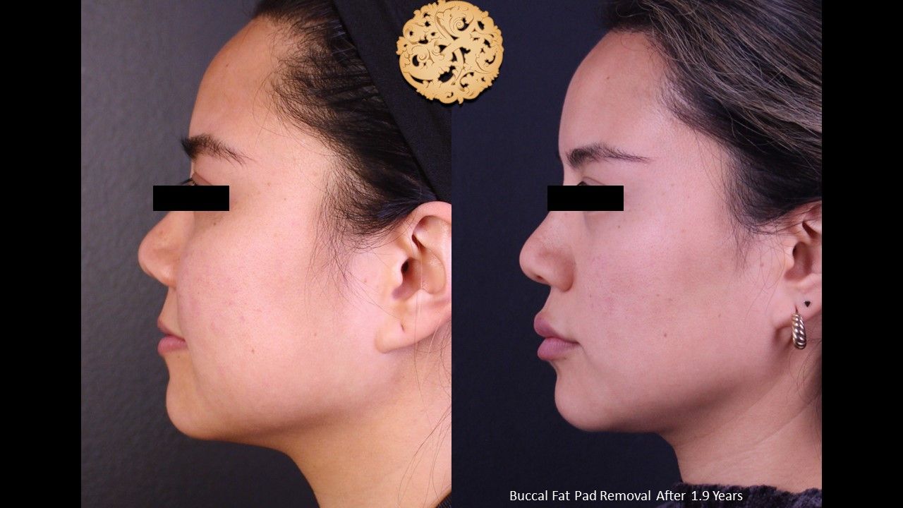 Buccal Fat Removal Before & After