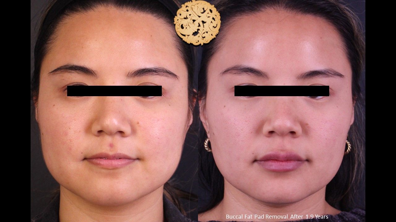 Buccal Fat Removal Before & After