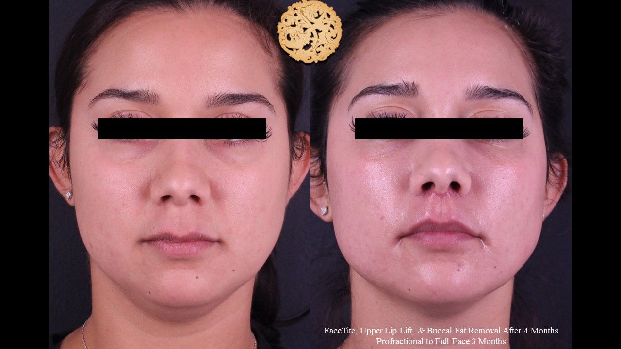 Buccal Fat Removal Before & After