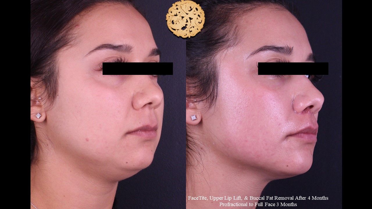 Buccal Fat Removal Before & After
