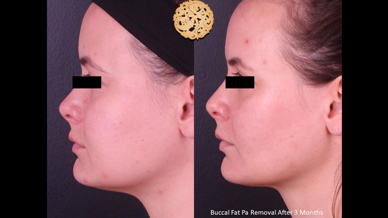 Buccal Fat Removal Before & After
