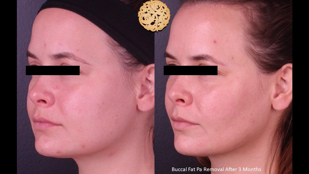 Buccal Fat Removal Before & After