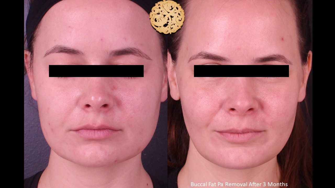 Buccal Fat Removal Before & After