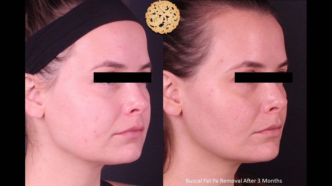 Buccal Fat Removal Before & After