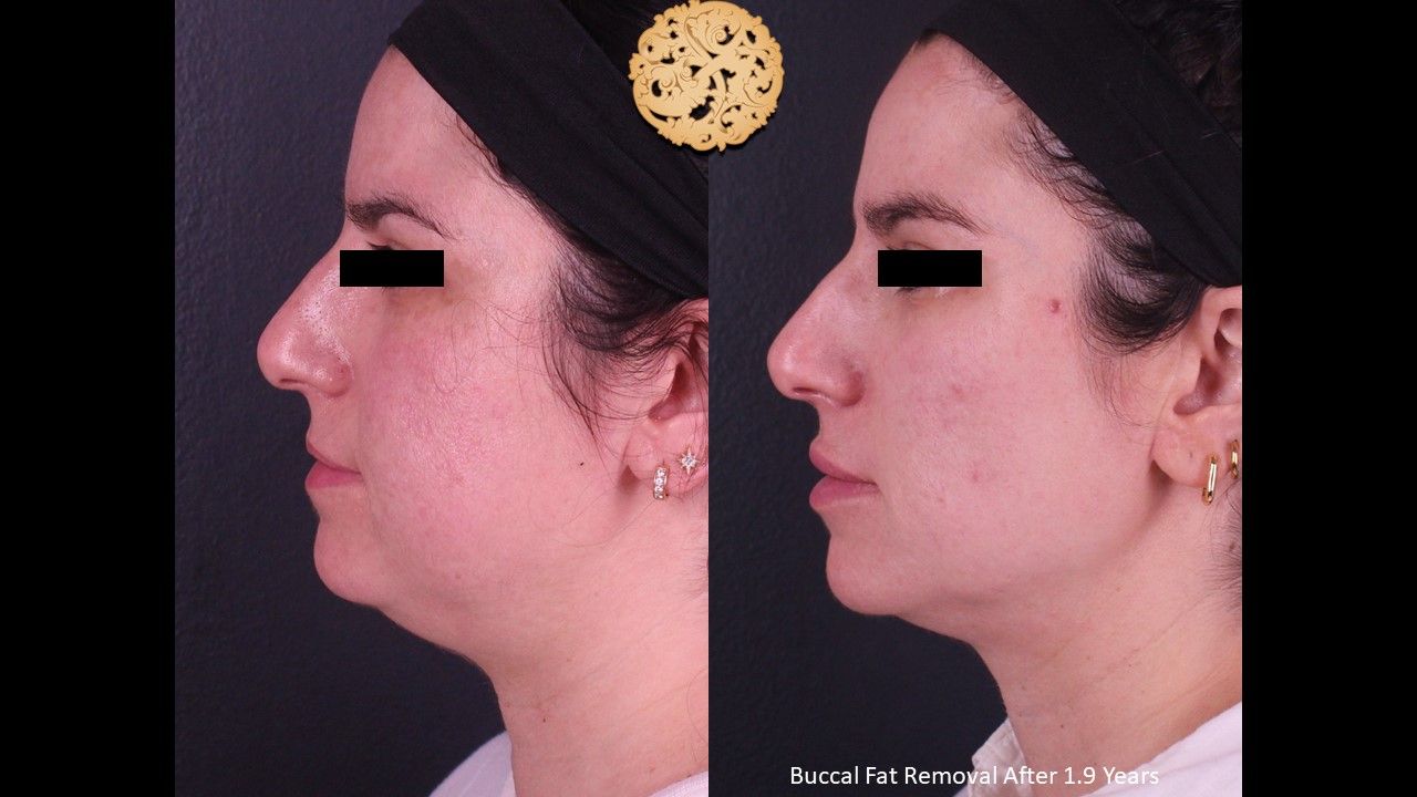 Buccal Fat Removal Before & After