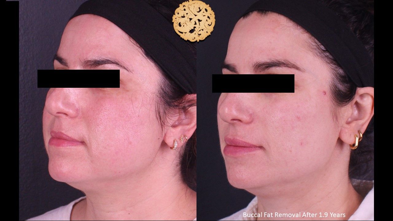 Buccal Fat Removal Before & After