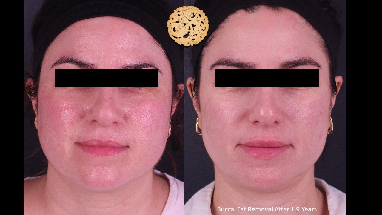 Buccal Fat Removal Before & After