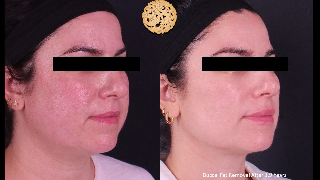Buccal Fat Removal Before & After