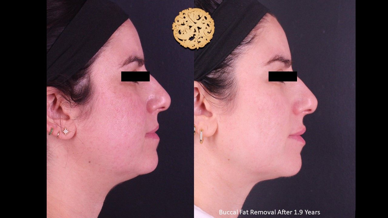 Buccal Fat Removal Before & After