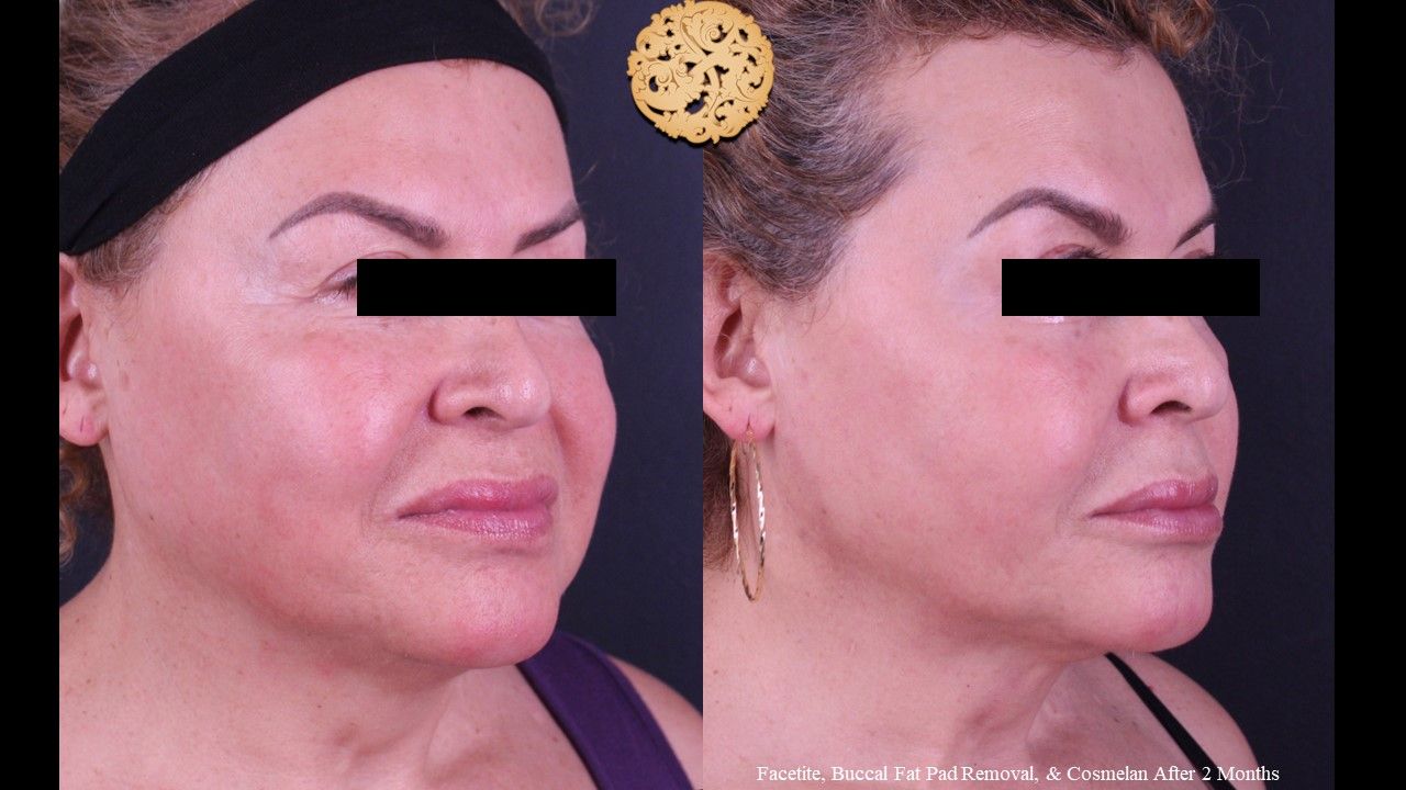 Buccal Fat Removal Before & After