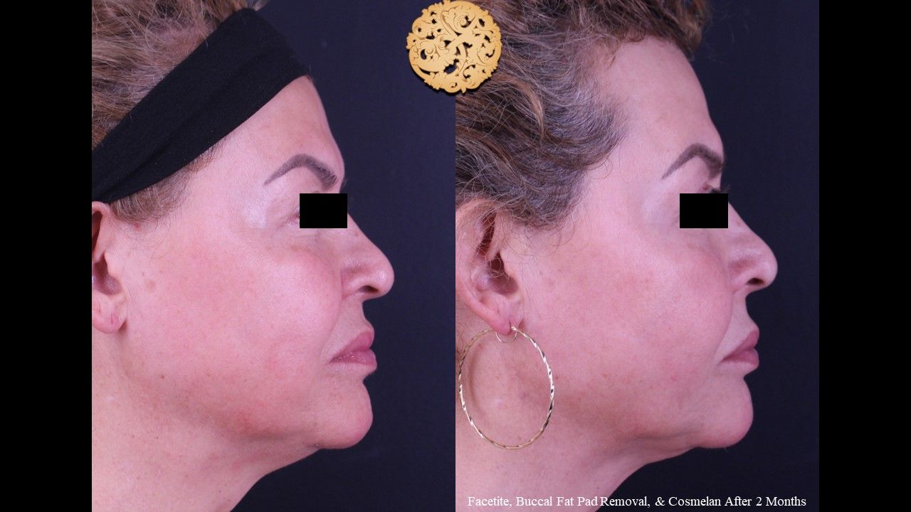 Buccal Fat Removal Before & After