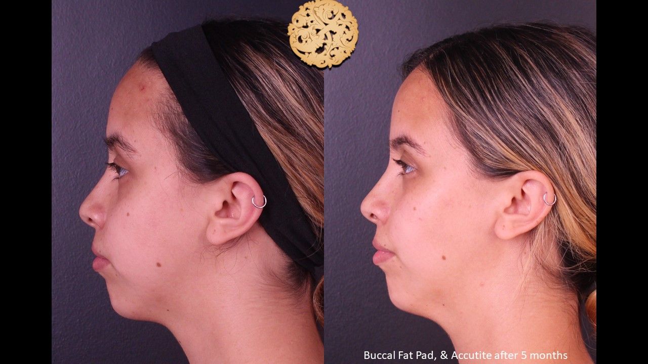 Buccal Fat Removal Before & After