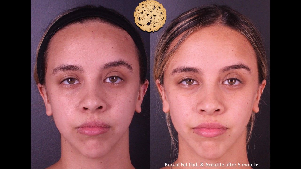 Buccal Fat Removal Before & After
