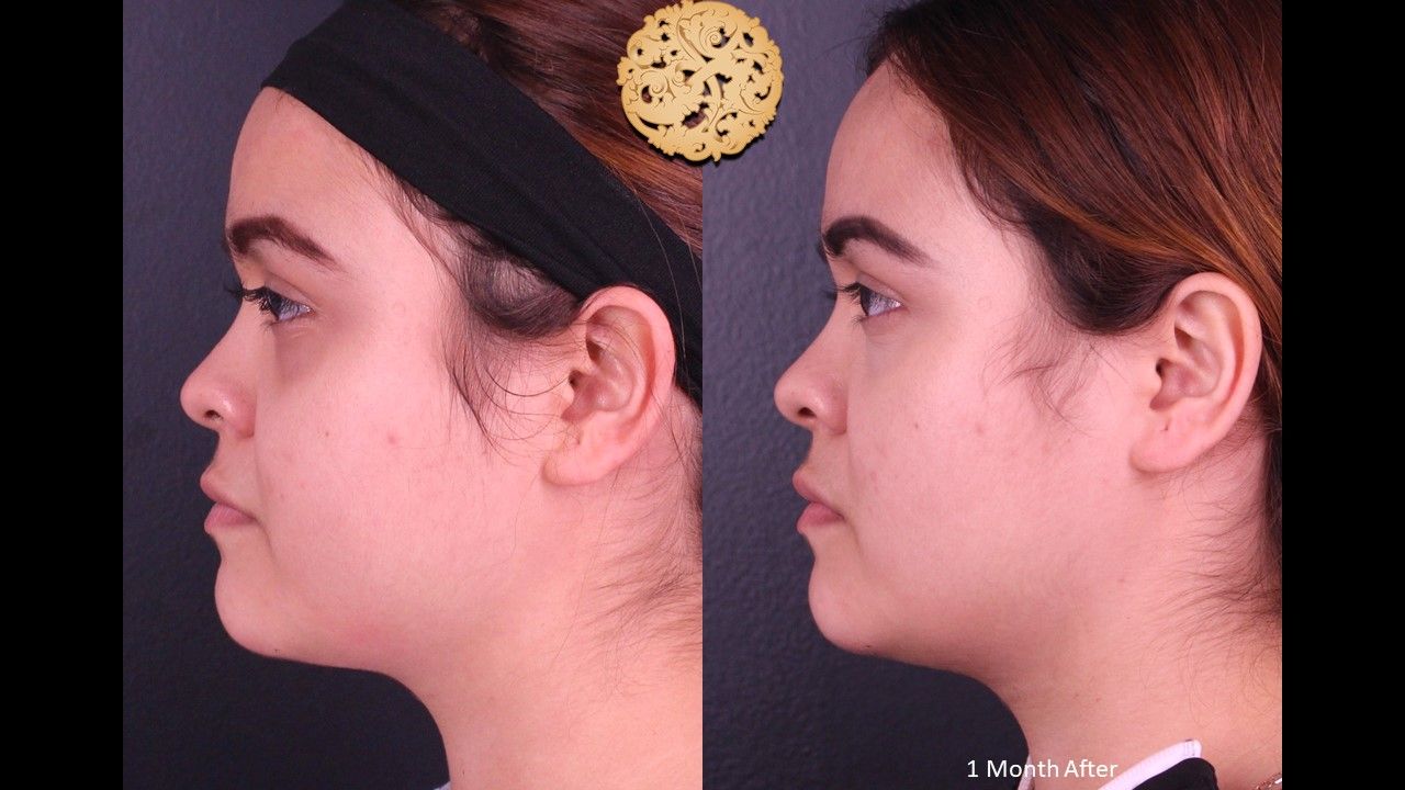 Buccal Fat Removal Before & After