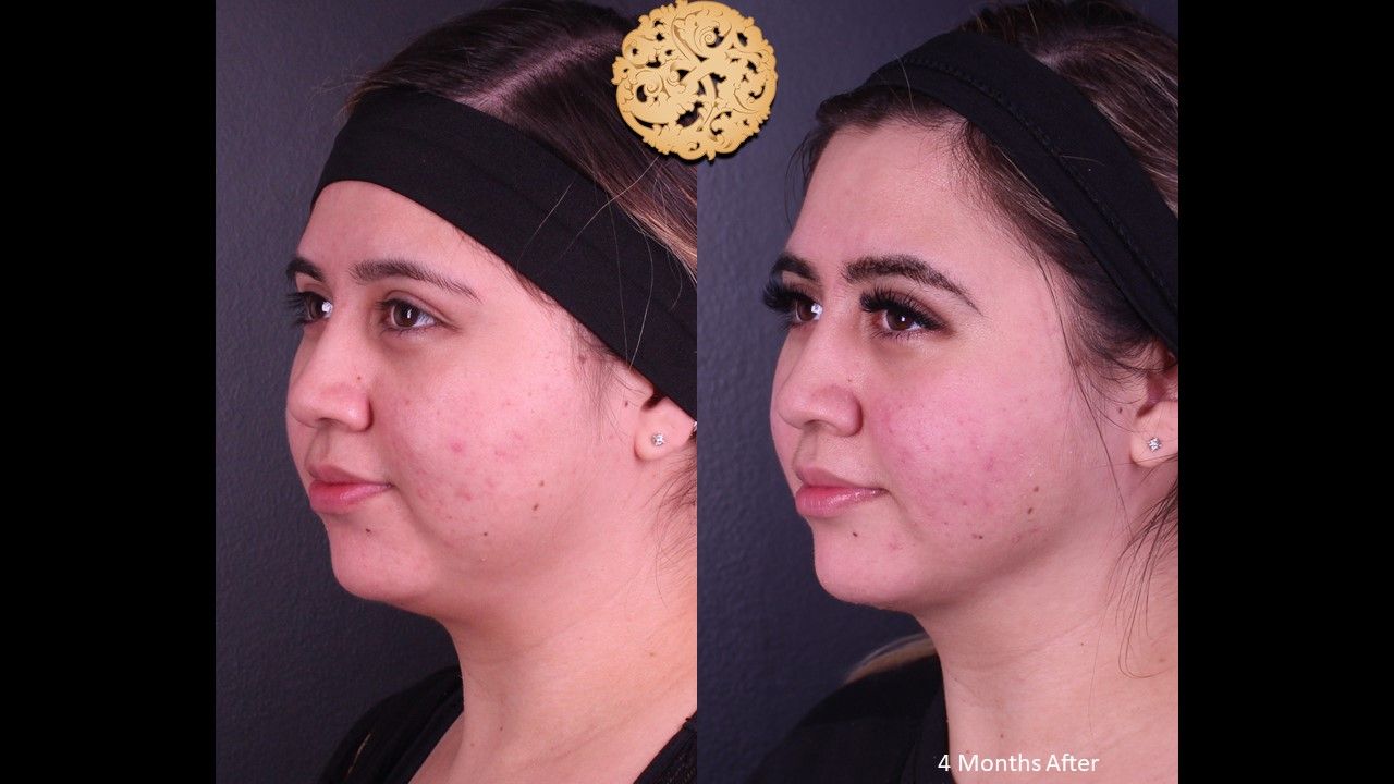 Buccal Fat Removal Before & After