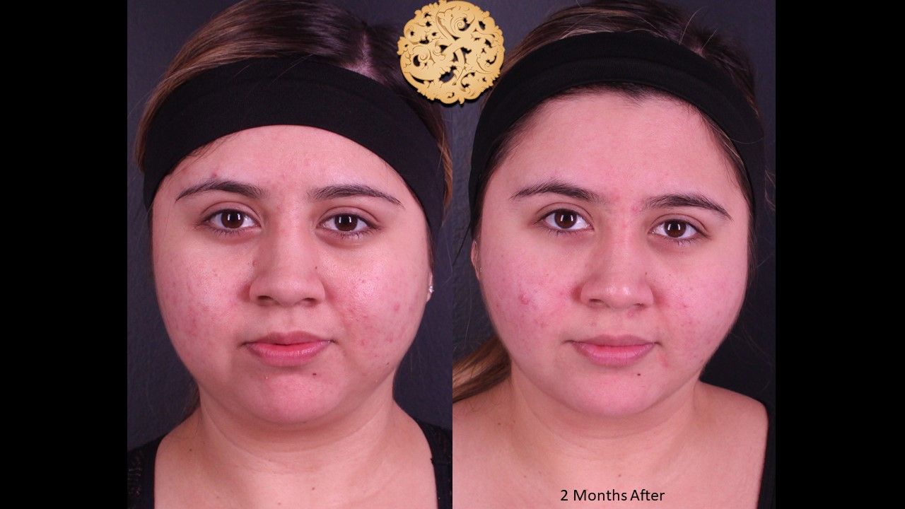 Buccal Fat Removal Before & After