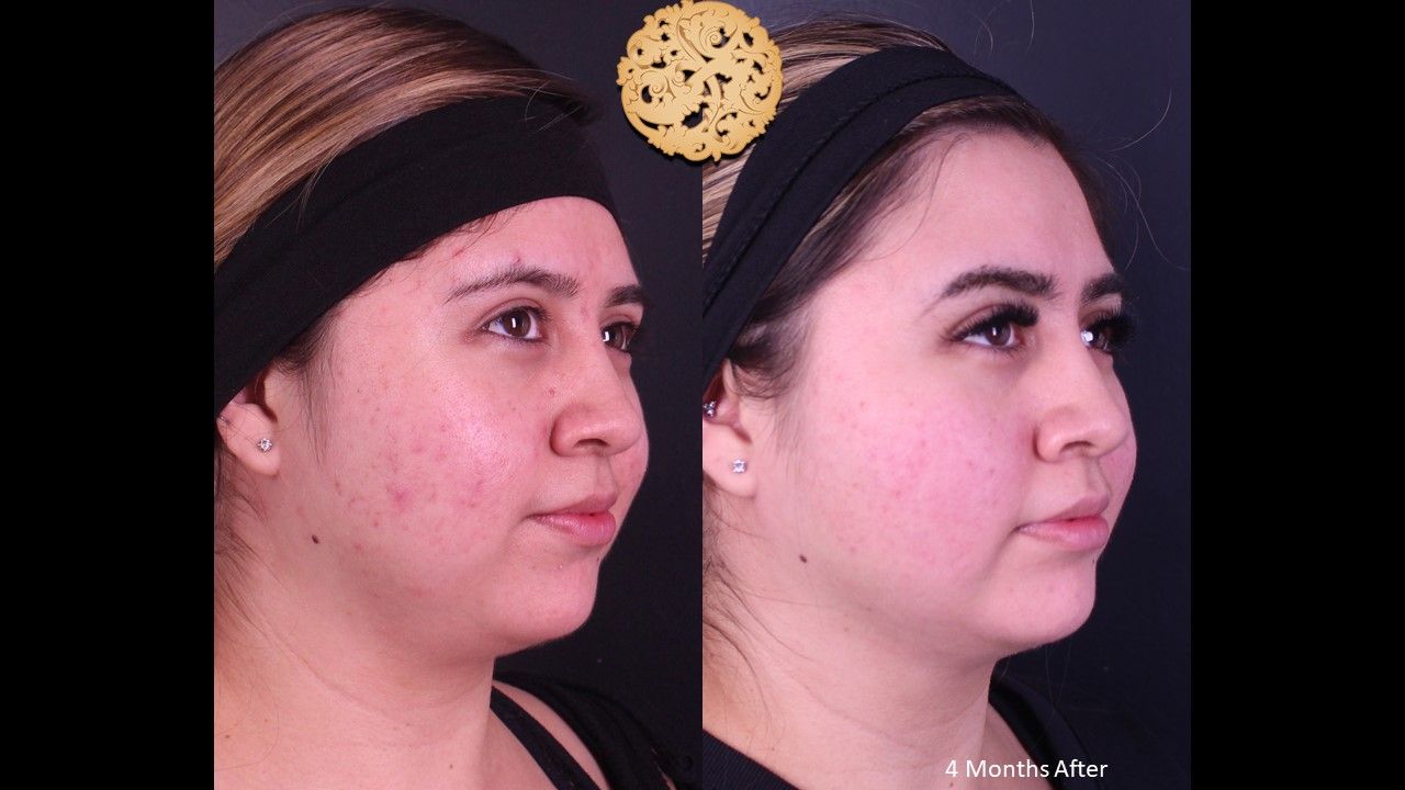 Buccal Fat Removal Before & After