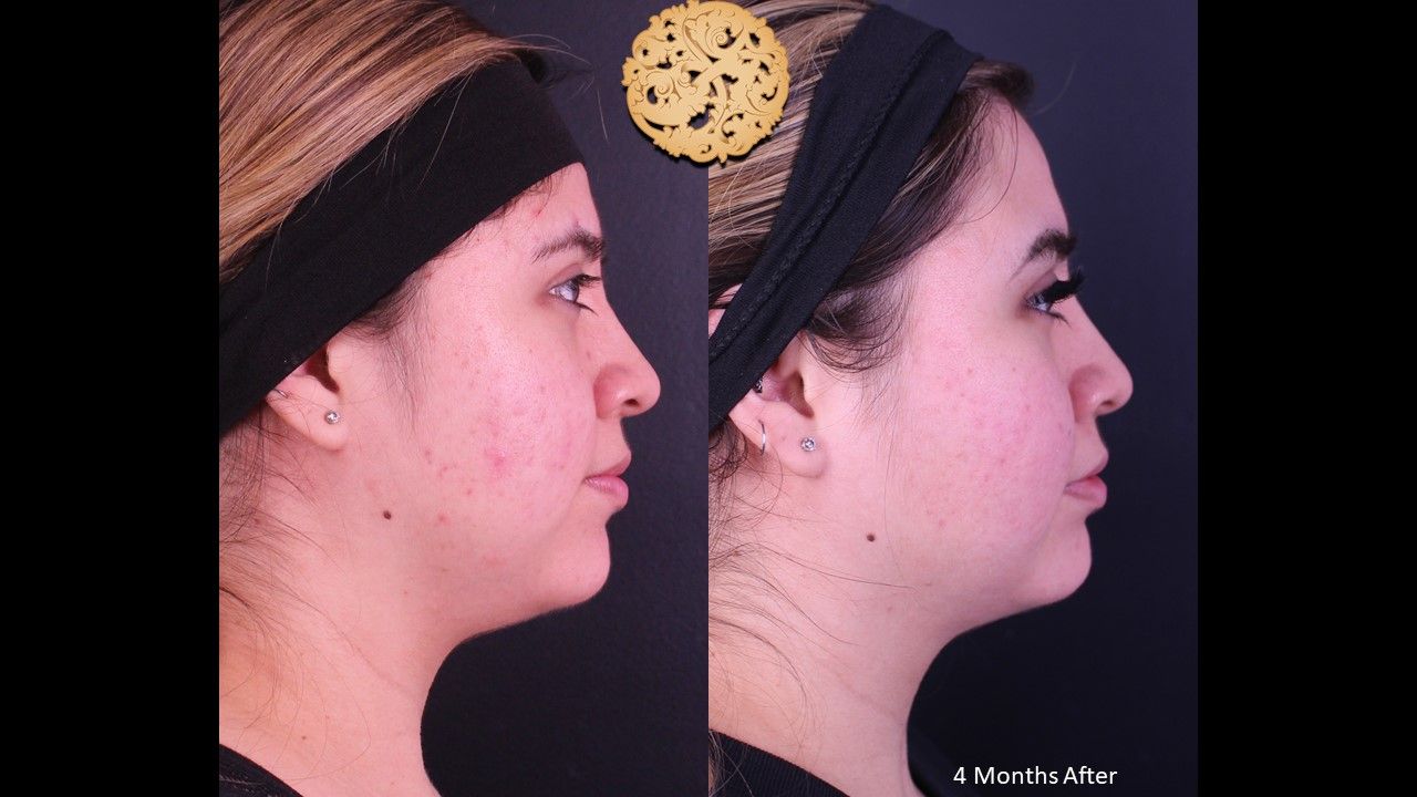 Buccal Fat Removal Before & After