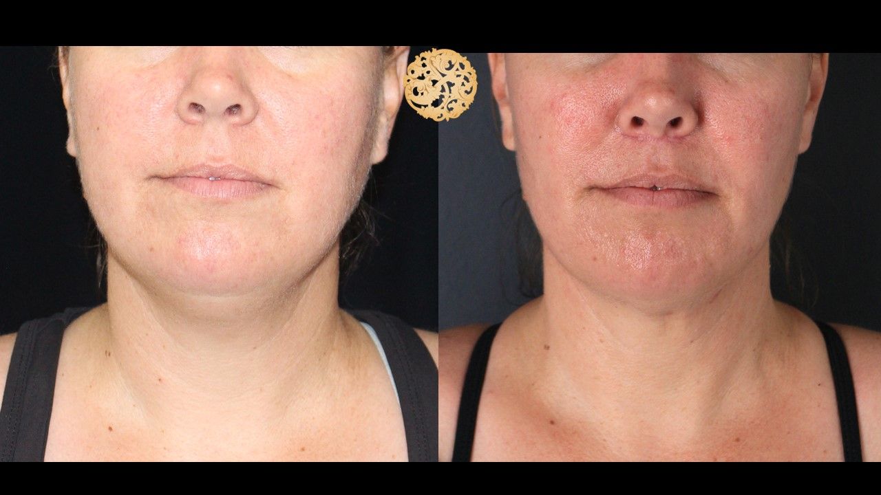Buccal Fat Removal Before & After
