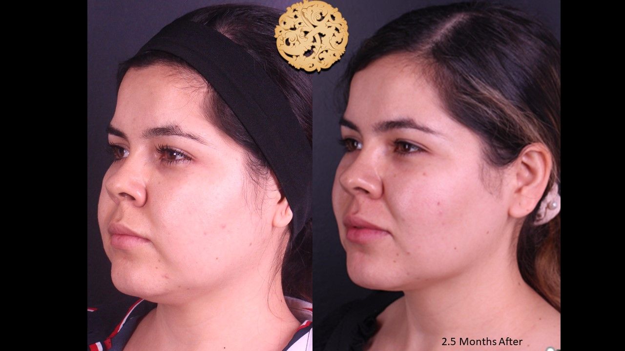 Buccal Fat Removal Before & After