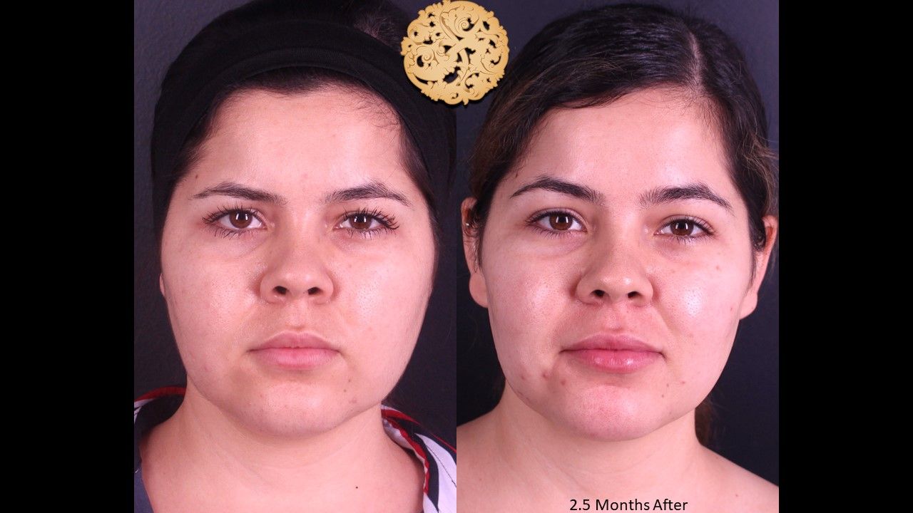 Buccal Fat Removal Before & After