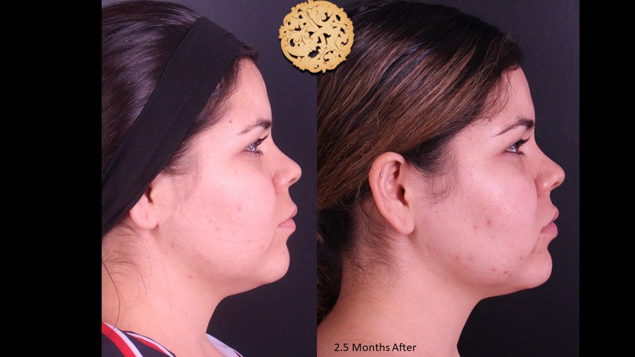 Buccal Fat Removal Before & After