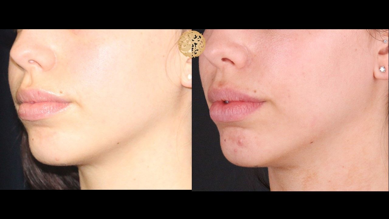 Buccal Fat Removal Before & After