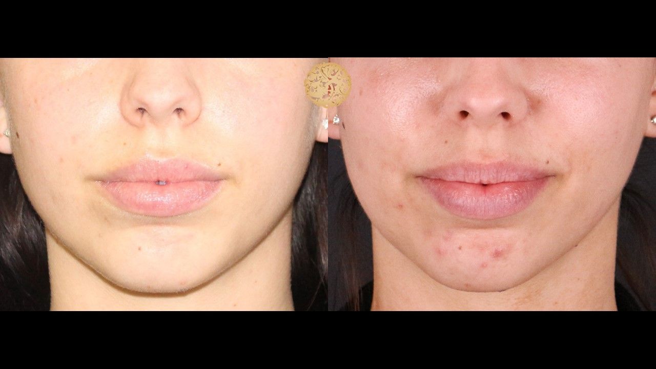 Buccal Fat Removal Before & After