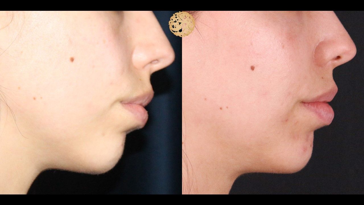 Buccal Fat Removal Before & After
