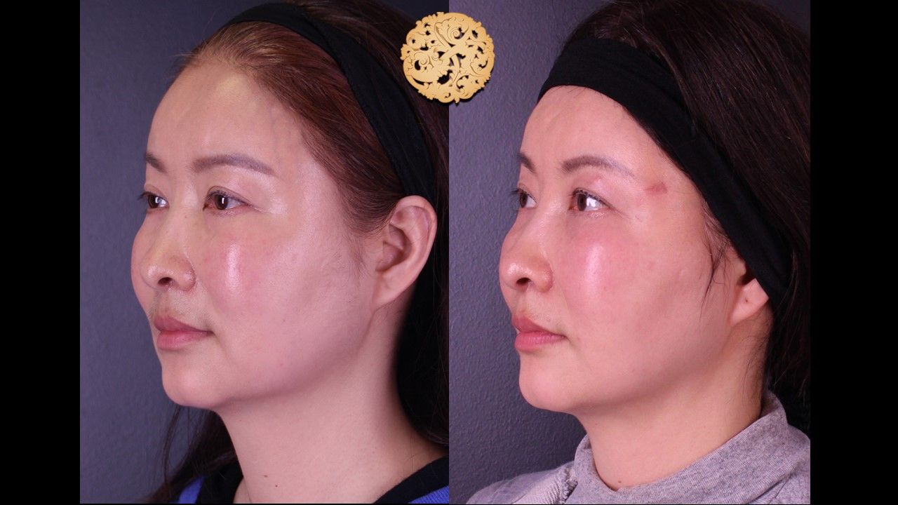 Buccal Fat Removal Before & After