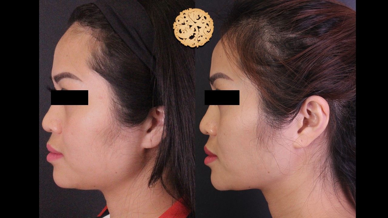 Buccal Fat Removal Before & After