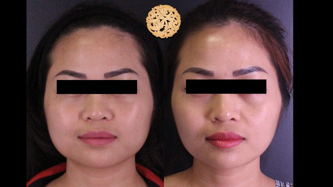 Buccal Fat Removal Before & After