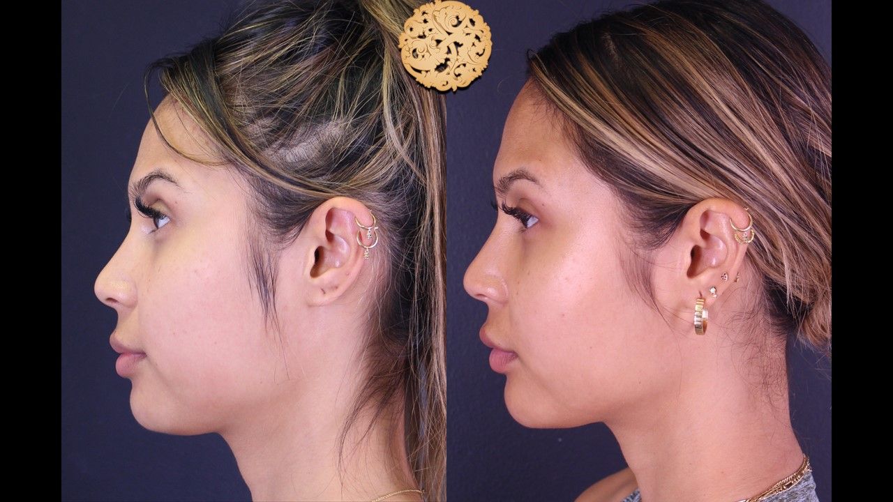 Buccal Fat Removal Before & After