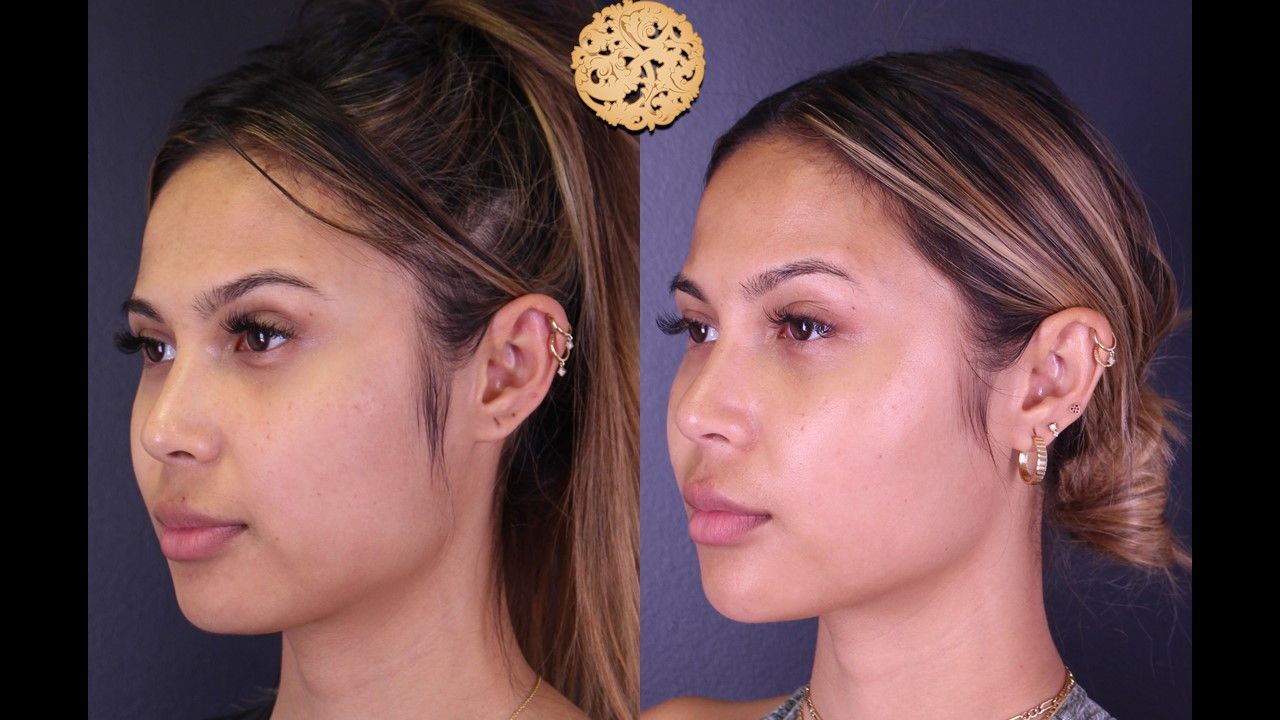 Buccal Fat Removal Before & After