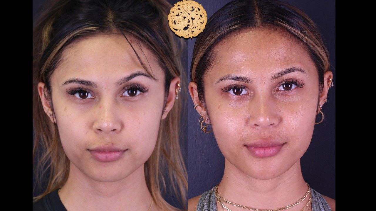 Buccal Fat Removal Before & After