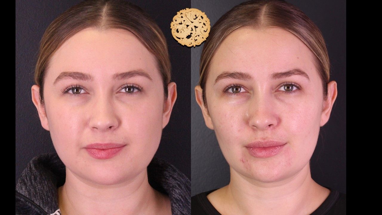 Buccal Fat Removal Before & After
