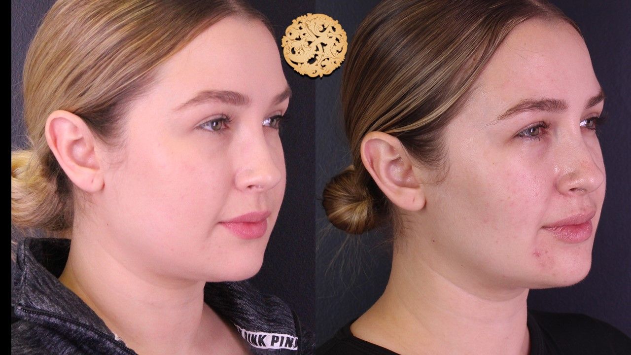 Buccal Fat Removal Before & After