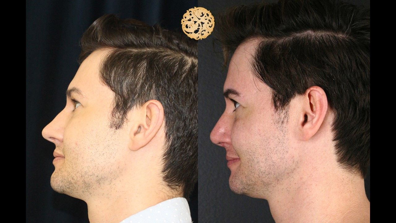 Buccal Fat Removal Before & After