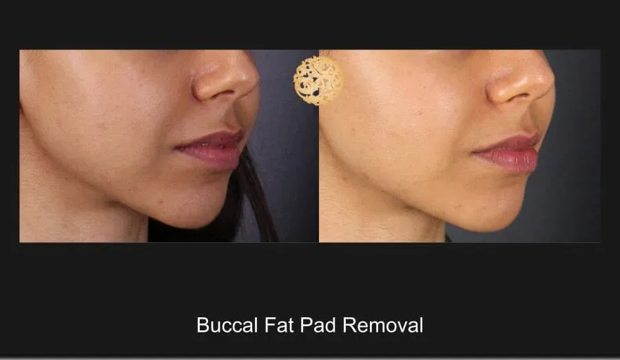 Buccal Fat Removal Before & After