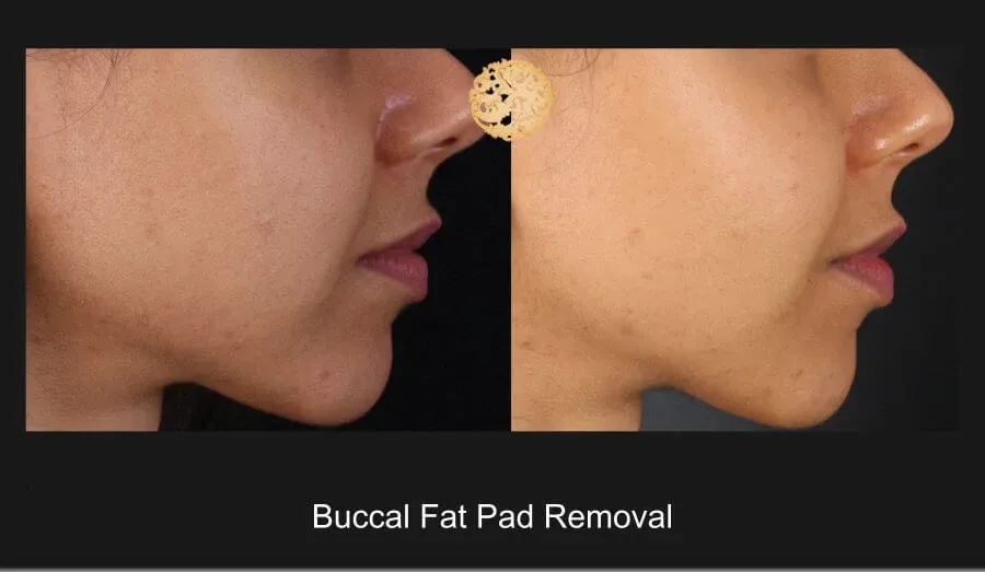 Buccal Fat Removal Before & After