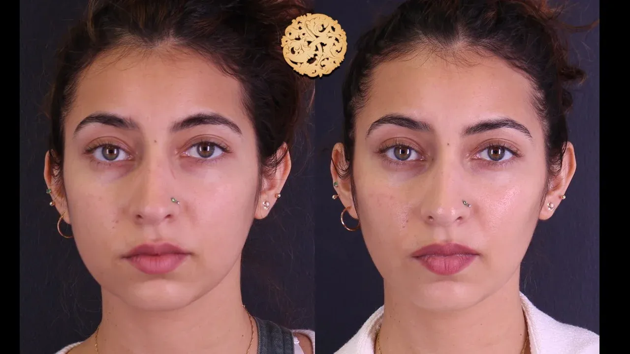 Buccal Fat Removal Before & After