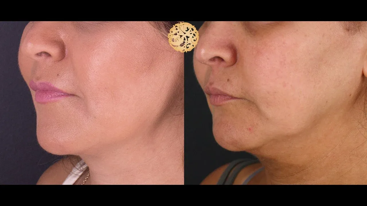 Buccal Fat Removal Before & After
