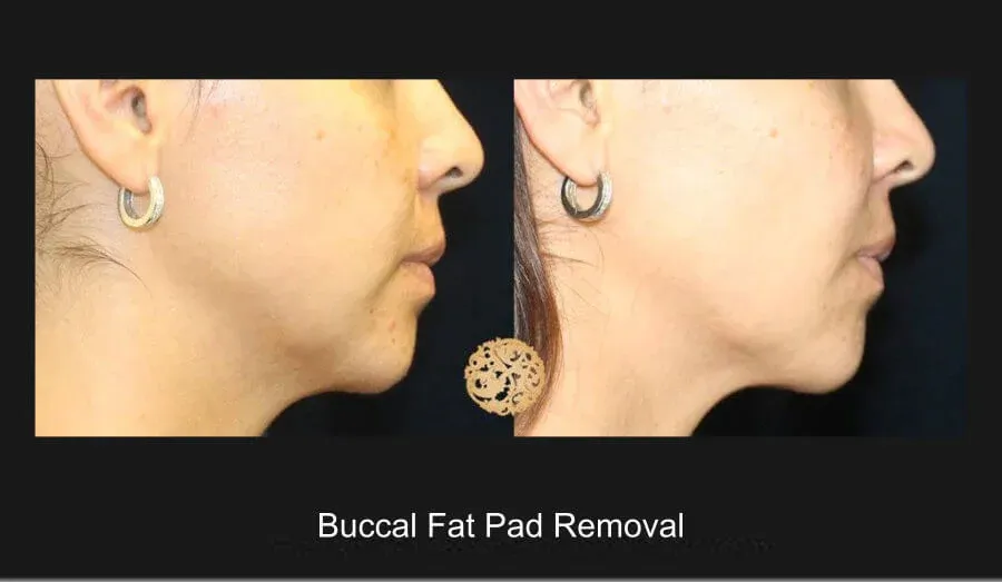 Buccal Fat Removal Before & After