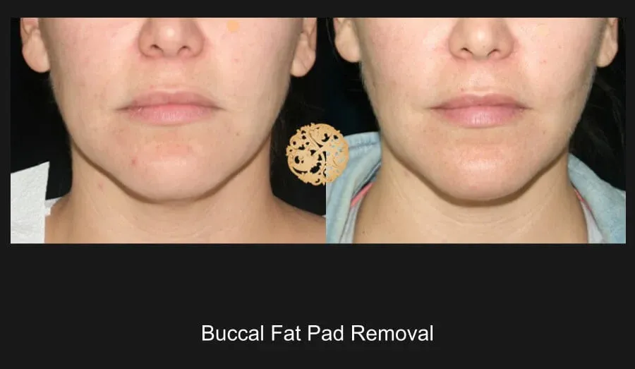 Buccal Fat Removal Before & After