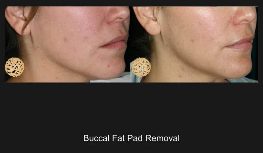 Buccal Fat Removal Before & After