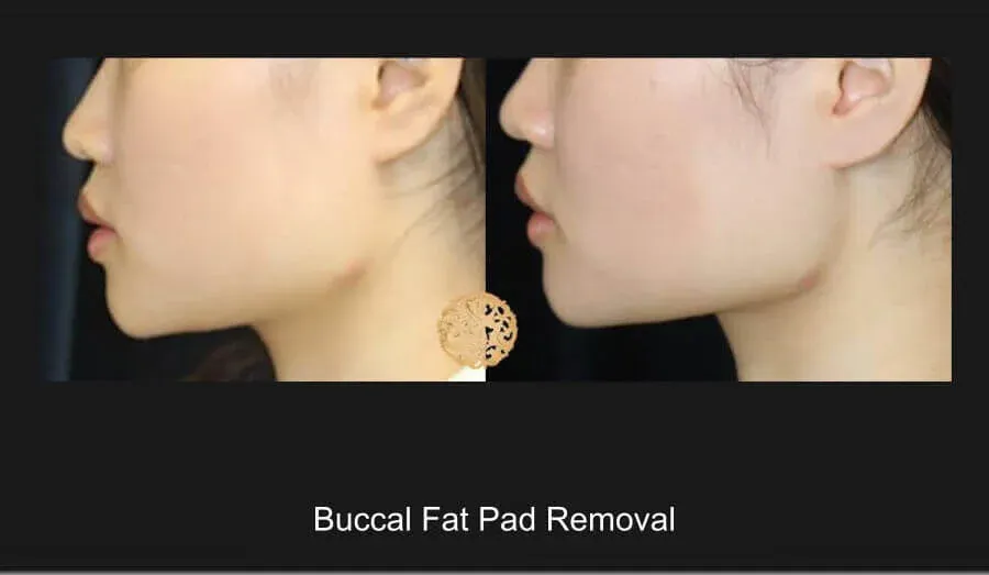 Buccal Fat Removal Before & After