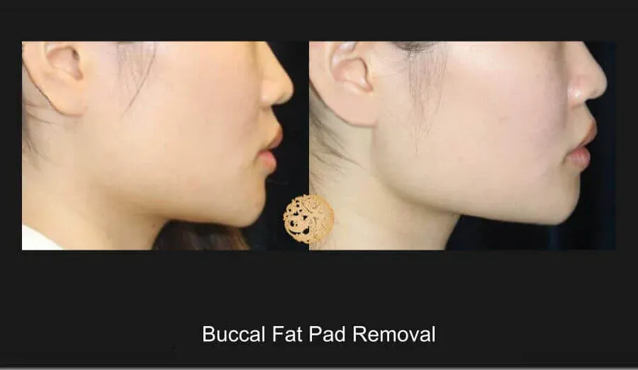 Buccal Fat Removal Before & After