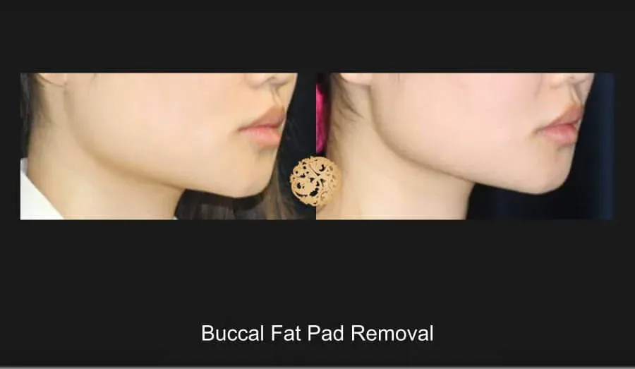 Buccal Fat Removal Before & After