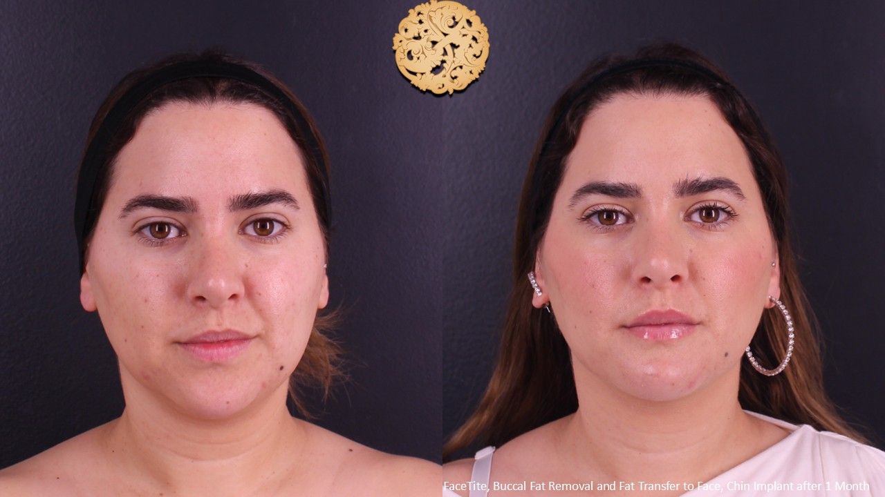 Buccal Fat Removal Before & After