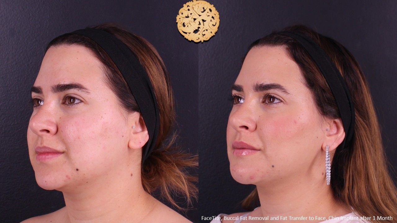 Buccal Fat Removal Before & After